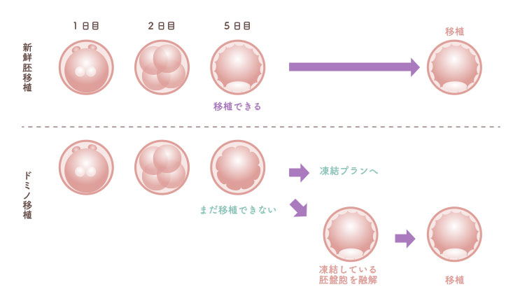 新鮮胚移植とドミノ移植